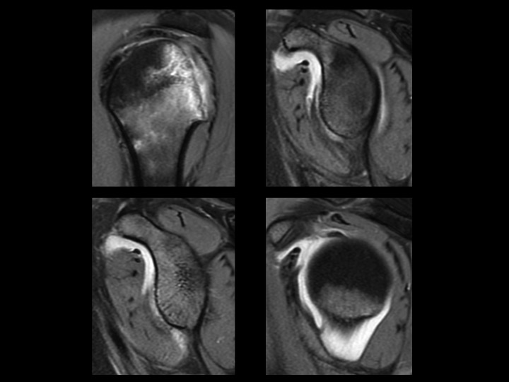 Figure 3 for case Glenoid Avulsion Glenohumeral Ligament